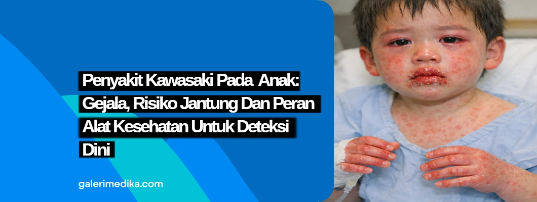 Penyakit Kawasaki pada Anak: Gejala, Risiko Jantung, dan Peran Alat Kesehatan untuk Deteksi Dini