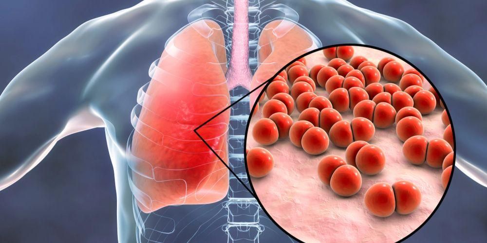 Pneumonia, Penyakit yang Berbahaya Jika Tidak Segera Ditangani