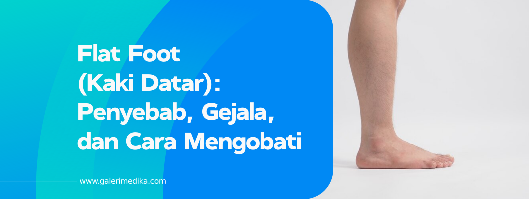 Flat Foot (Kaki Datar): Penyebab, Gejala, dan Cara Mengobati