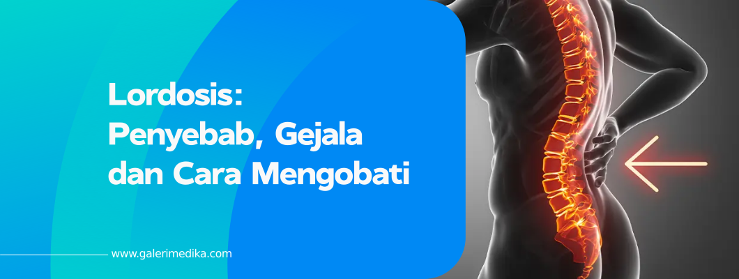Lordosis: Penyebab, Gejala dan Cara Mengobati