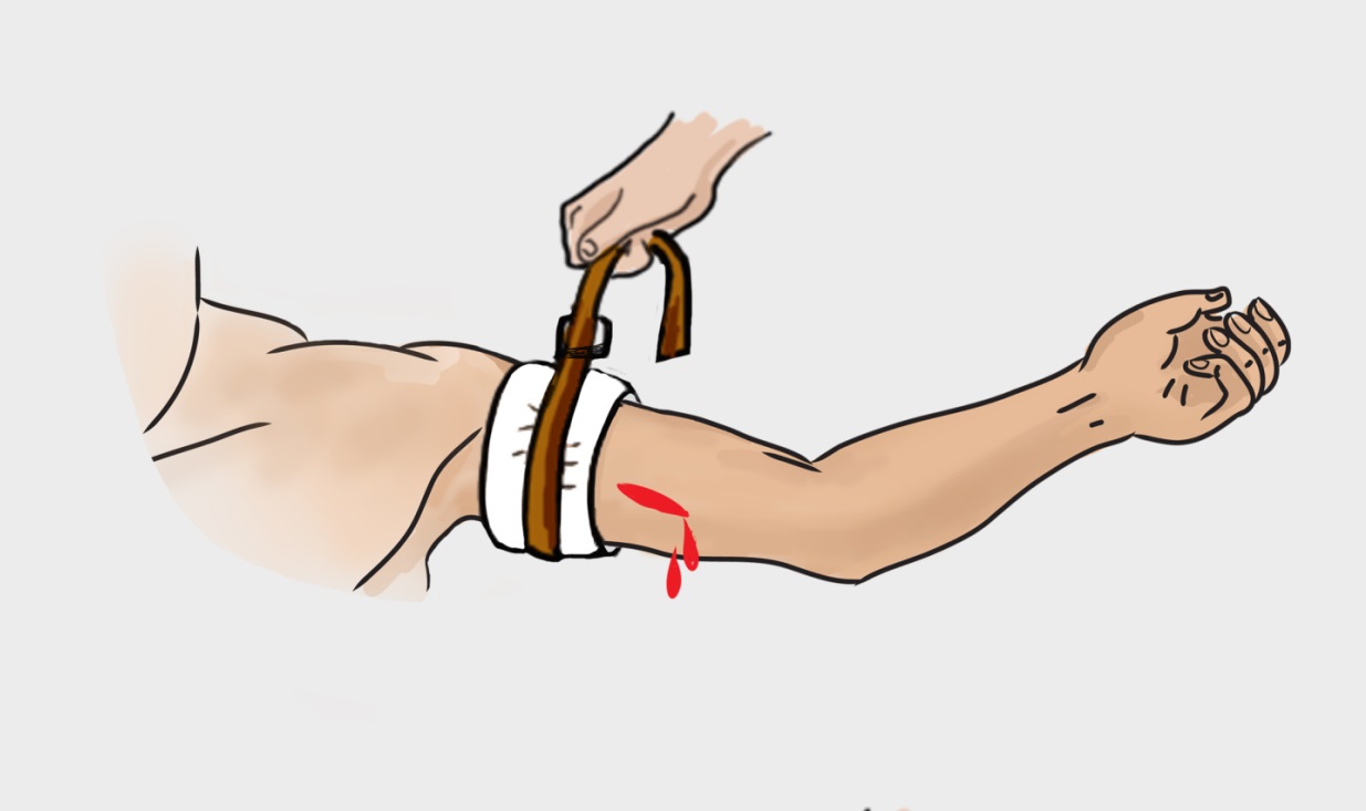 Pedoman Cara Menggunakan Tourniquet Yang Baik Dan Benar