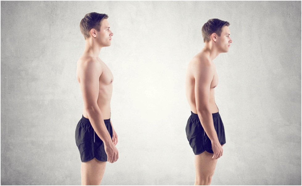 Kifosis, Penyakit Tulang Belakang yang Bisa Terjadi Bahkan pada Anak Anda